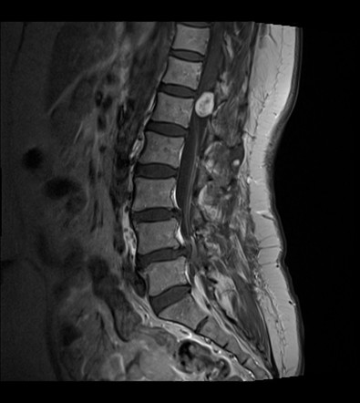 Spinal Schwannoma Radiology Reference Article Radiopaedia Org