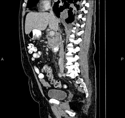 Locally Advanced Metastatic Pancreatic Cancer Image Radiopaedia Org