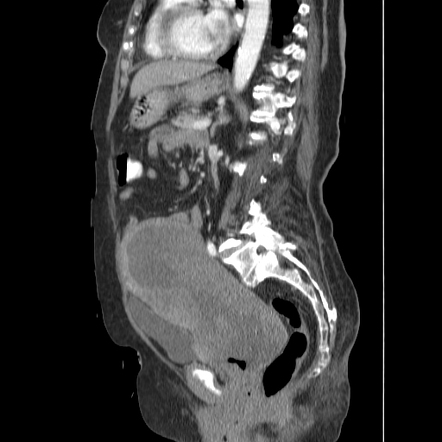 Serous Carcinoma Of The Endometrium Radiology Reference Article