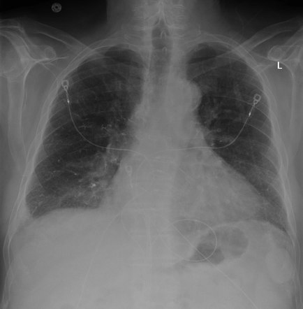 Pulmonary Cement Embolism Image Radiopaedia Org