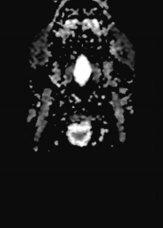 Lingual Thyroglossal Duct Cyst Image Radiopaedia Org