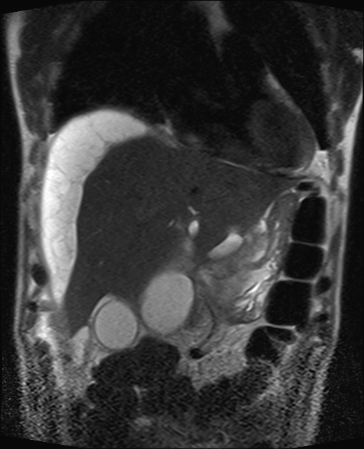 Hepatic Subcapsular Pseudocyst Image Radiopaedia Org