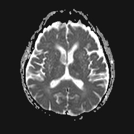 Thalamic Aphasia Image Radiopaedia Org