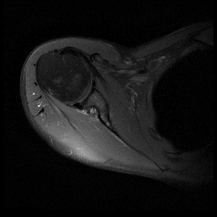 Calcific Tendinitis Supraspinatus Tendon Radiology Case