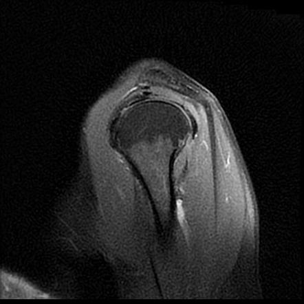 Calcific Tendinitis Supraspinatus Tendon Image Radiopaedia Org