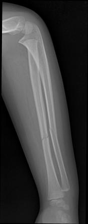 Radius And Ulnar Shaft Fractures Radiology Case Radiopaedia Org