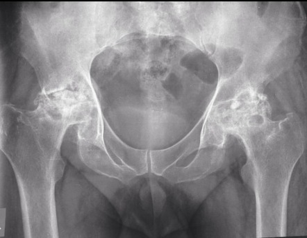 Ficat And Arlet Classification Of Avascular Necrosis Of Femoral Head