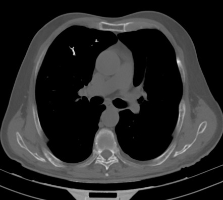 Pulmonary Cement Embolism Radiology Reference Article Radiopaedia Org