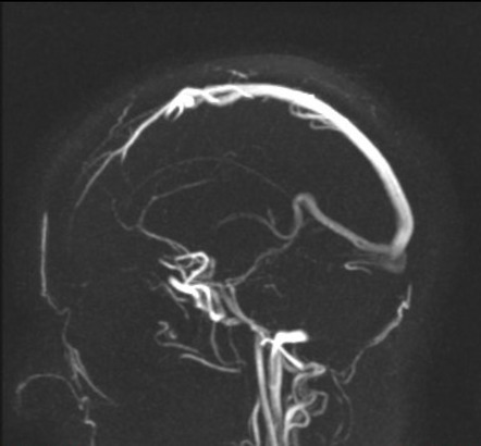 Intracranial Hypotension Image Radiopaedia Org