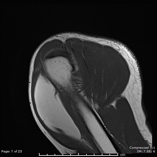 Heart Shaped Intramuscular Lipoma Image Radiopaedia Org