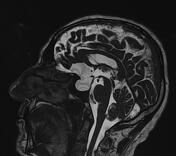 Suprasellar Arachnoid Cyst Radiology Reference Article Radiopaedia Org