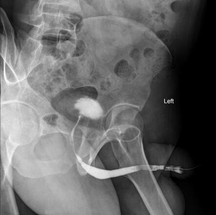 Short Segment Bulbar Urethral Stricture Image Radiopaedia Org