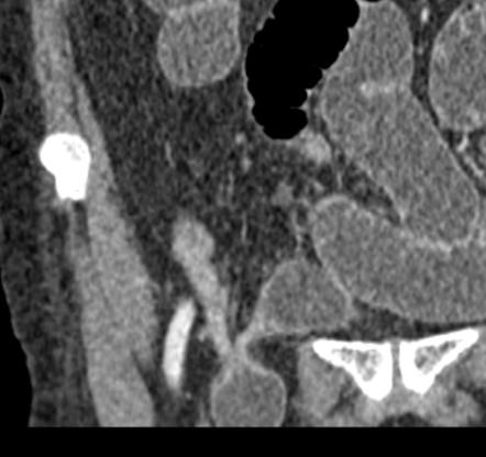 Small Bowel Obstruction Due To An Incarcerated Femoral Hernia