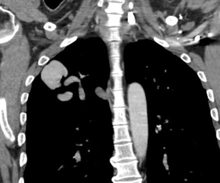 Pulmonary Arteriovenous Malformation Image Radiopaedia Org