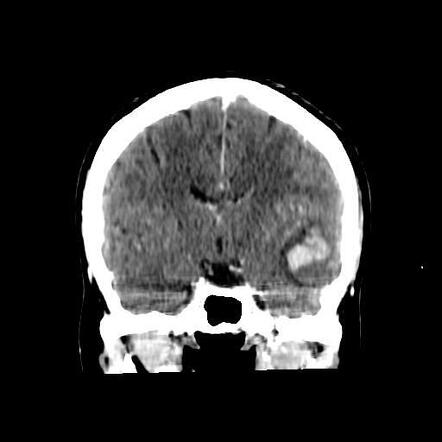 Cerebral Venous Thrombosis With Hemorrhagic Venous Infarction Image