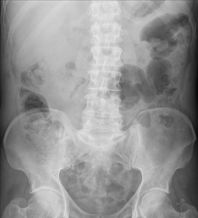 Hemorrhagic Cholecystitis Image Radiopaedia Org