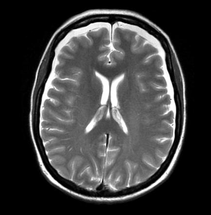 Intracranial Hypotension Radiology Reference Article Radiopaedia Org