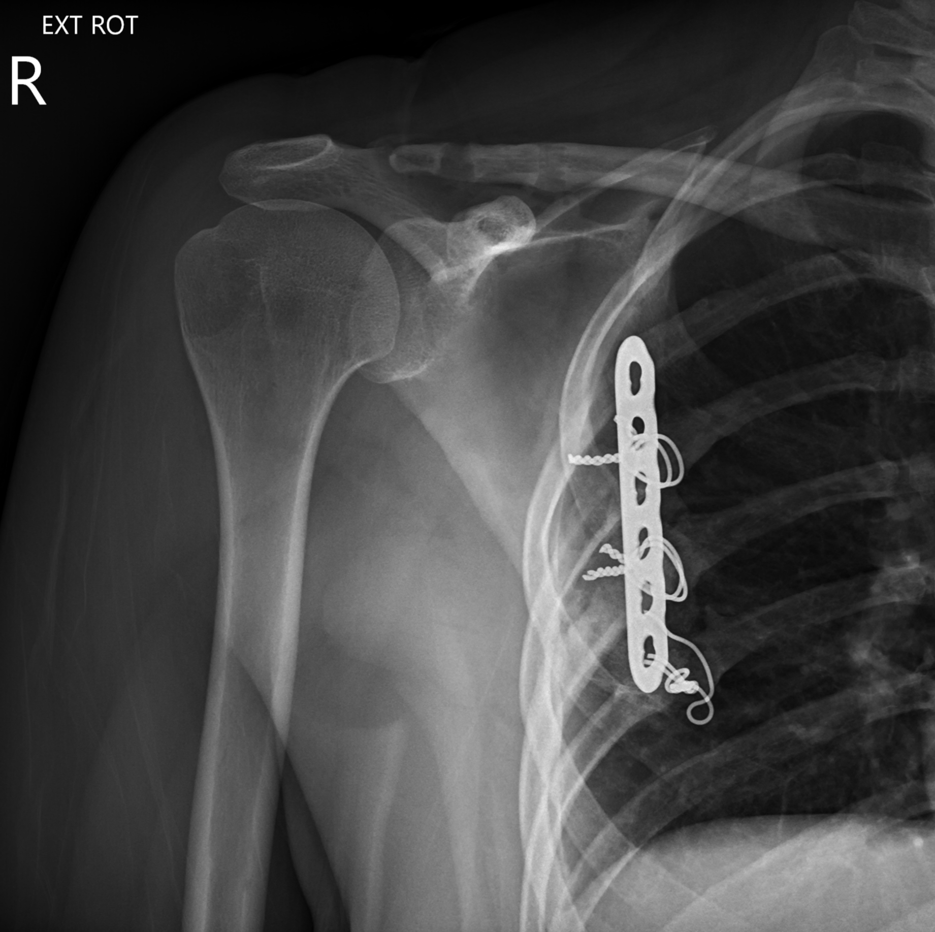 Scapulothoracic Fusion Image Radiopaedia Org