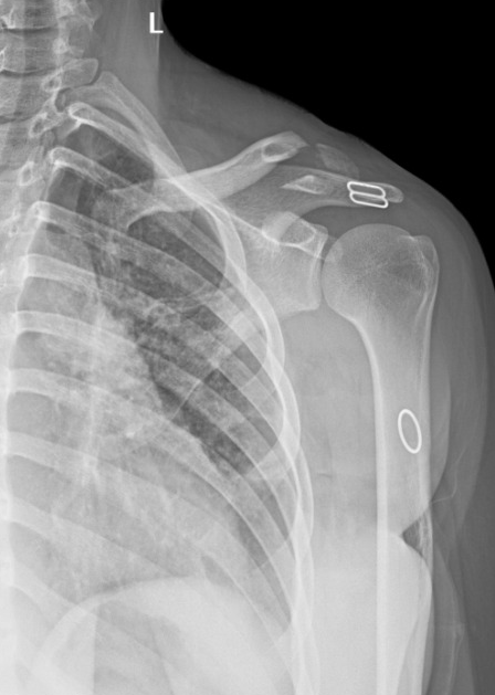 Clavicle Fracture Distal Third Image Radiopaedia Org