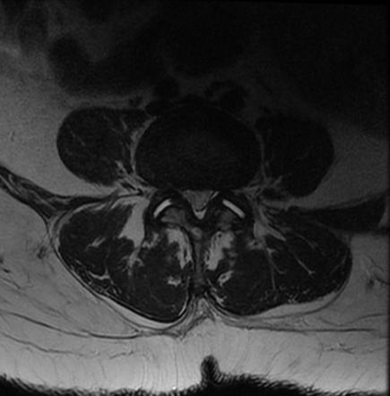 Intraspinal Synovial Cyst Image Radiopaedia Org