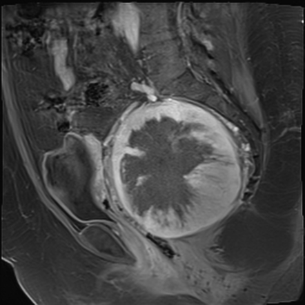 Retroperitoneal Solitary Fibrous Tumor With Malignant Transformation