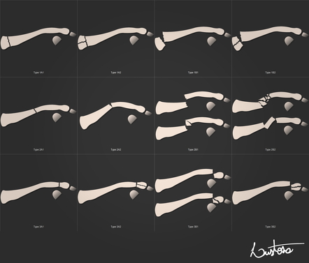 Robinson Classification Of Clavicle Fractures Radiology Case