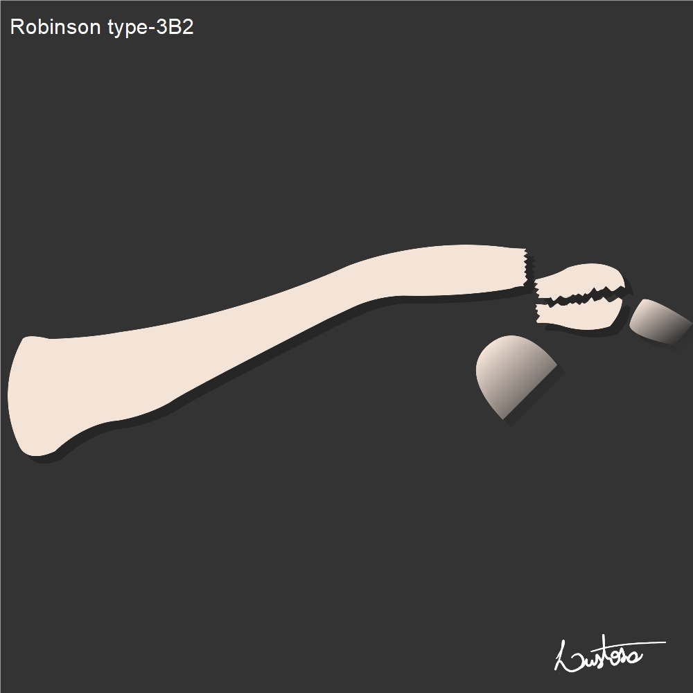 Robinson Classification Of Clavicle Fractures Image Radiopaedia Org