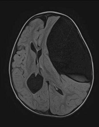 Compressive Arachnoid Cyst Middle Cranial Fossa Radiology Case