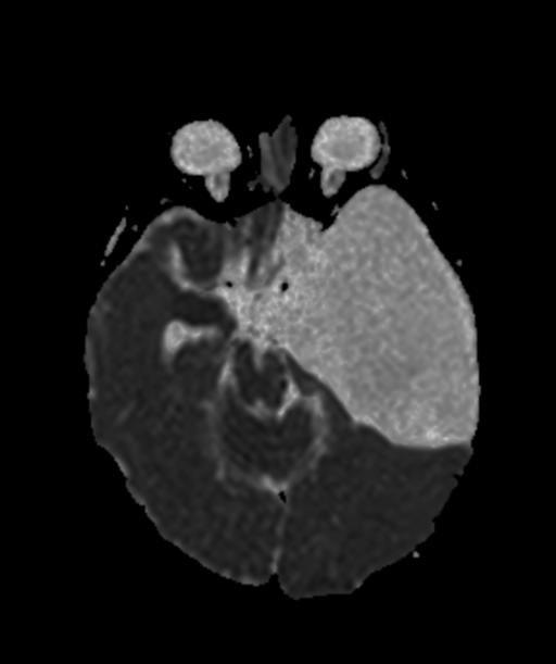 Compressive Arachnoid Cyst Middle Cranial Fossa Image Radiopaedia Org