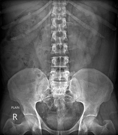 Megacalycosis Image Radiopaedia Org