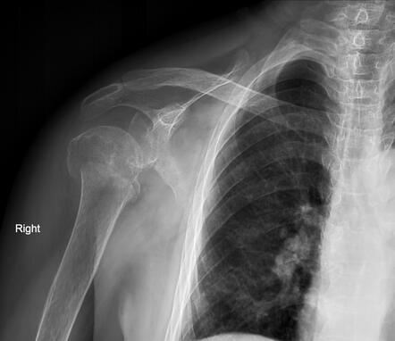 Neer Classification Of Proximal Humeral Fractures Radiology Reference Article Radiopaedia Org