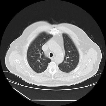 Aberrant Right Subclavian Artery Radiology Case Radiopaedia Org