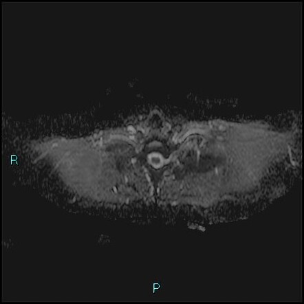 Extra Abdominal Desmoid Fibromatosis Image Radiopaedia Org