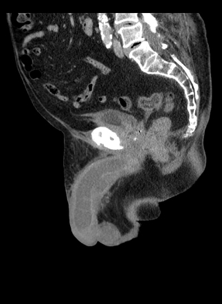 Corpus Cavernosum Abscess Radiology Case Radiopaedia Org