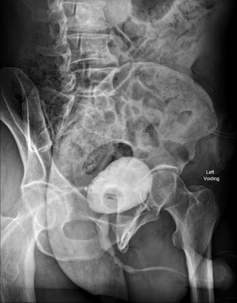 Long Segment Bulbar Urethral Stricture Image Radiopaedia Org