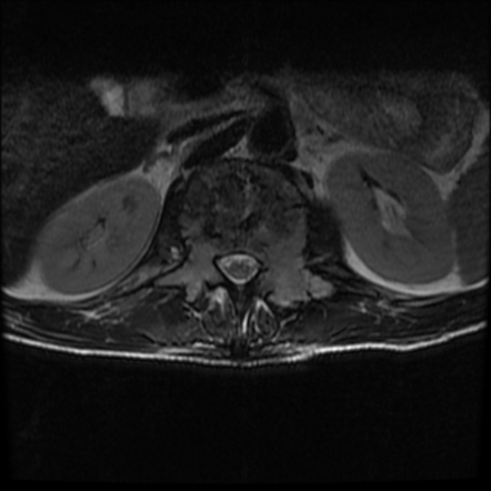 Solitary Bone Plasmacytoma Pet Ct Image Radiopaedia Org