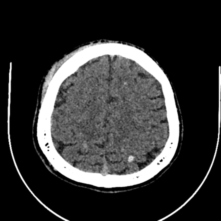 Diffuse Axonal Injury Grade I Radiology Case Radiopaedia Org