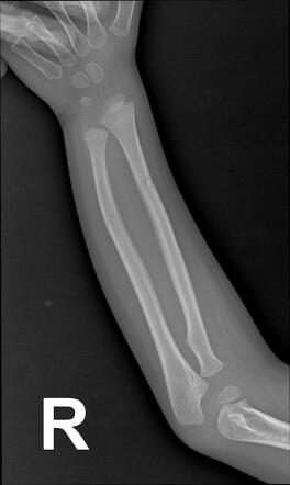 Radius And Ulnar Shaft Fractures Image Radiopaedia Org