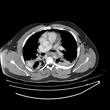 Superficial Femoral Artery Occlusion Image Radiopaediaorg