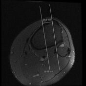 Patellar Translation Tt Tg Distance Radiology Reference Article