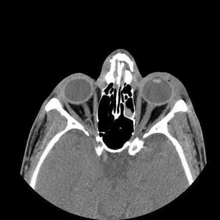 Nasal Bones Fracture Dislocation And Distended Lacrimal Sacs