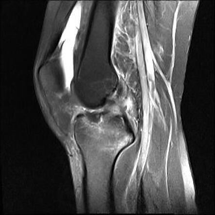 Concomitant Complete Tear Of Mcl And Acl Avulsion Fracture In Right