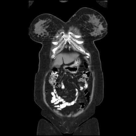 Invasive Ductal Carcinoma In Left Breast Radiology Case Radiopaedia Org