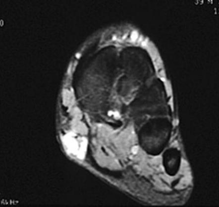 Plantar Fibromatosis Mri