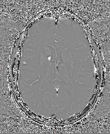 Radiation Induced Meningiomas And Cavernous Malformations Image