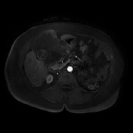 Gallbladder Carcinoma Radiology Case Radiopaedia Org