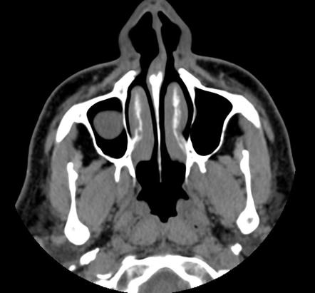 Sinus Mucous Retention Cyst Radiology Case Radiopaedia Org