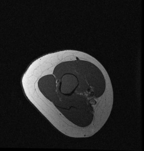 Unicameral Bone Cyst Image Radiopaedia Org