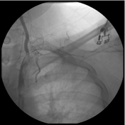 Viewing Playlist Angio Radiopaedia Org