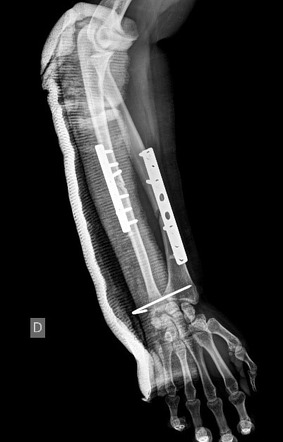 Galeazzi Fracture Dislocation With Follow Up Image Radiopaedia Org